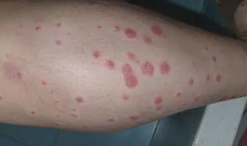 广州肤康皮肤病医院