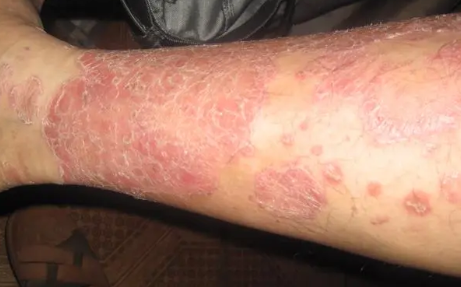 广州肤康皮肤病医院